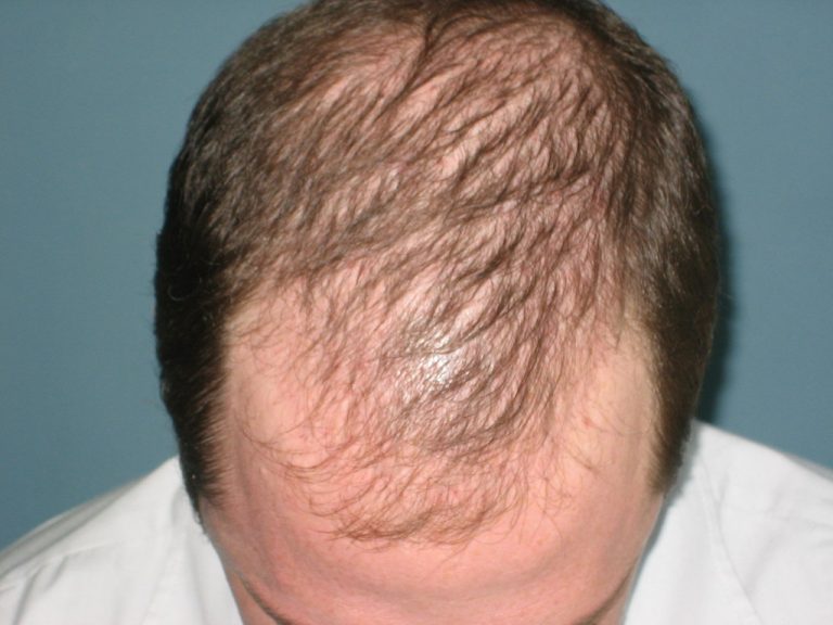 Syphilis Hair Loss 5930