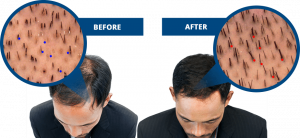 diffuse hair loss
